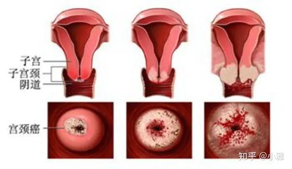 宫颈癌术后能补硒吗(宫颈癌康复期可以吃硒片吗)-硒宝网