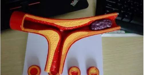 补硒对脑梗有作用吗(脑梗补硒管用吗)-硒宝网