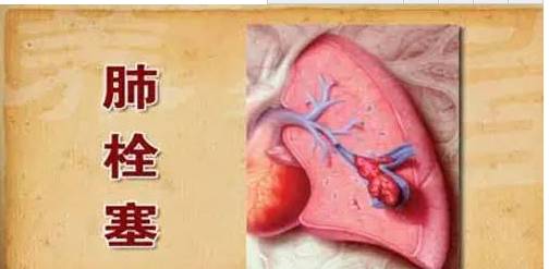 补硒对脑梗有作用吗(脑梗补硒管用吗)-硒宝网