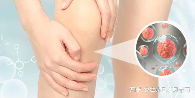 补硒对关节炎的好处（关节炎补钙有效果吗）-硒宝网