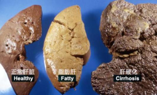 补硒对脂肪肝的作用（脂肪肝吃硒有什么用）-硒宝网