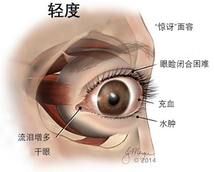 甲亢突眼补硒有用吗（补充硒对甲亢突眼有用吗）-硒宝网