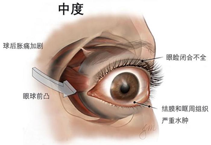 甲亢突眼补硒有用吗（补充硒对甲亢突眼有用吗）-硒宝网