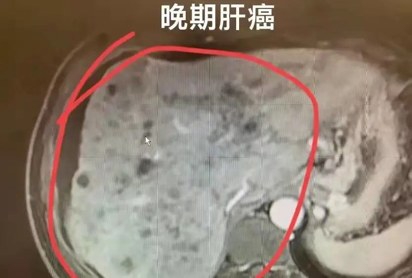 抗乙肝病毒补硒治愈（乙肝患者补硒有用吗）-硒宝网