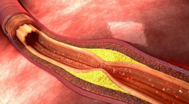 三高人群可以补硒么(补硒能降低三高吗)-硒宝网