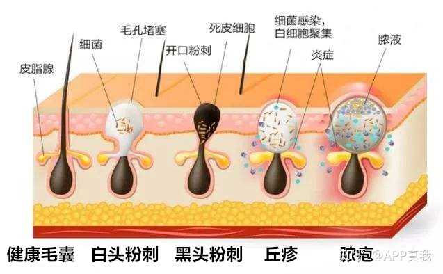 补硒会不会长痘印呢(吃硒片长痘痘)-硒宝网