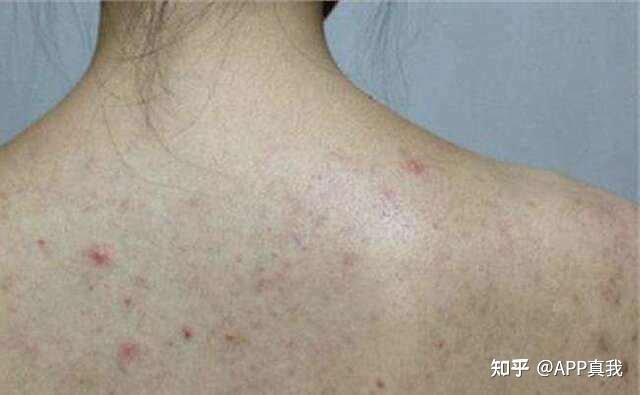 补硒会不会长痘印呢(吃硒片长痘痘)-硒宝网