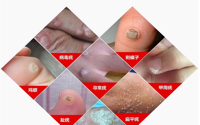 补硒可以治扁平疣吗(治补扁平疣硒可以用吗)-硒宝网