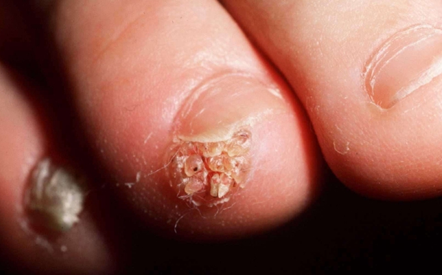 补硒可以治扁平疣吗(治补扁平疣硒可以用吗)-硒宝网