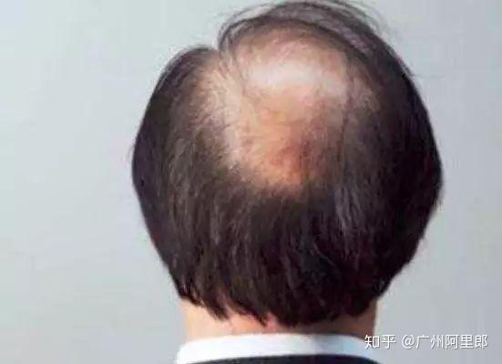 正常补硒会掉头发吗(补硒掉头发吗)-硒宝网