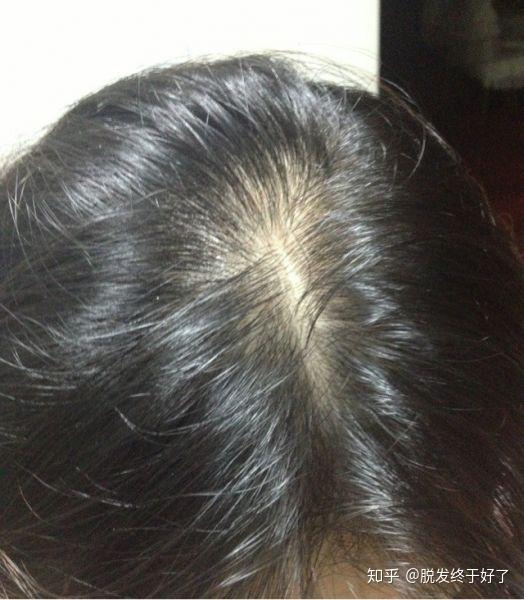 正常补硒会掉头发吗(补硒后头发不怎么掉了)-硒宝网
