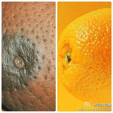 脑动脉瘤可以补硒吗(脑动脉瘤补硒可以治好吗)-硒宝网