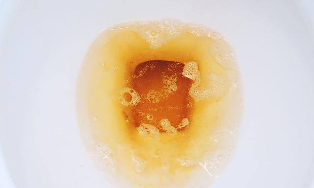 脑动脉瘤可以补硒吗(脑动脉瘤补硒可以治好吗)-硒宝网