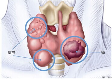 甲状腺癌后能补硒吗（甲状腺癌补硒要补几个月）-硒宝网