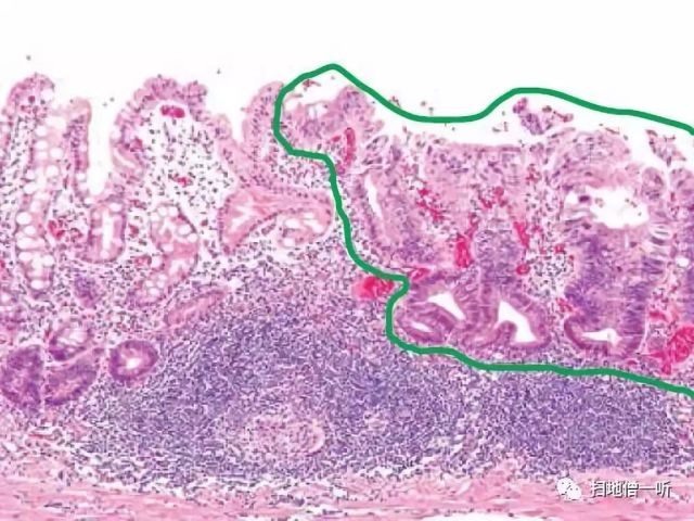 浅表性胃炎能补硒吗(浅表性胃炎能吃硒吗)-硒宝网