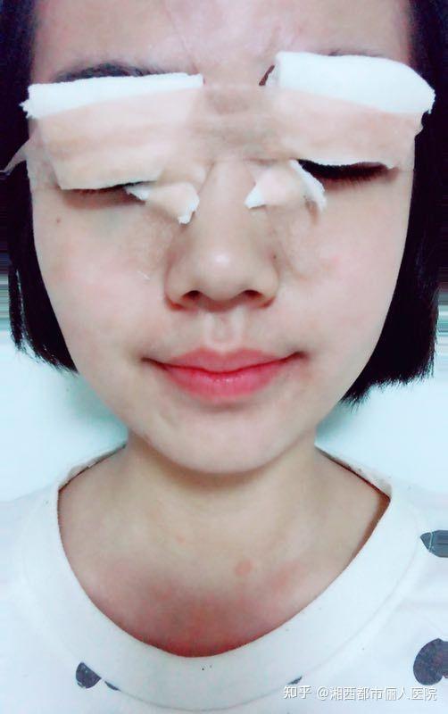 补硒能引起眼睛肿吗（眼肿是缺维生素吗）-硒宝网