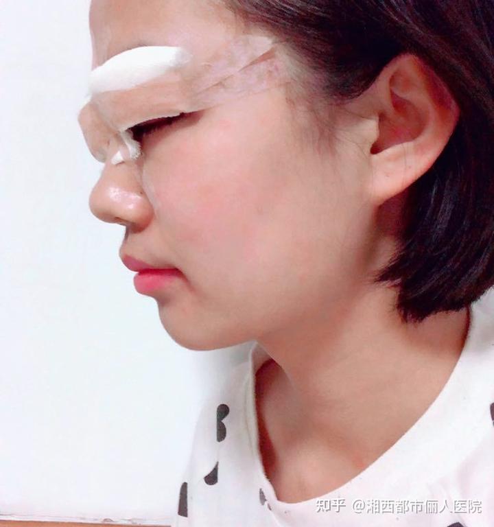 补硒能引起眼睛肿吗（眼肿是缺维生素吗）-硒宝网