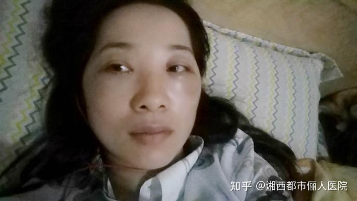 补硒能引起眼睛肿吗（眼肿是缺维生素吗）-硒宝网