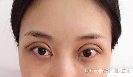 补硒能引起眼睛肿吗（眼肿是缺维生素吗）-硒宝网