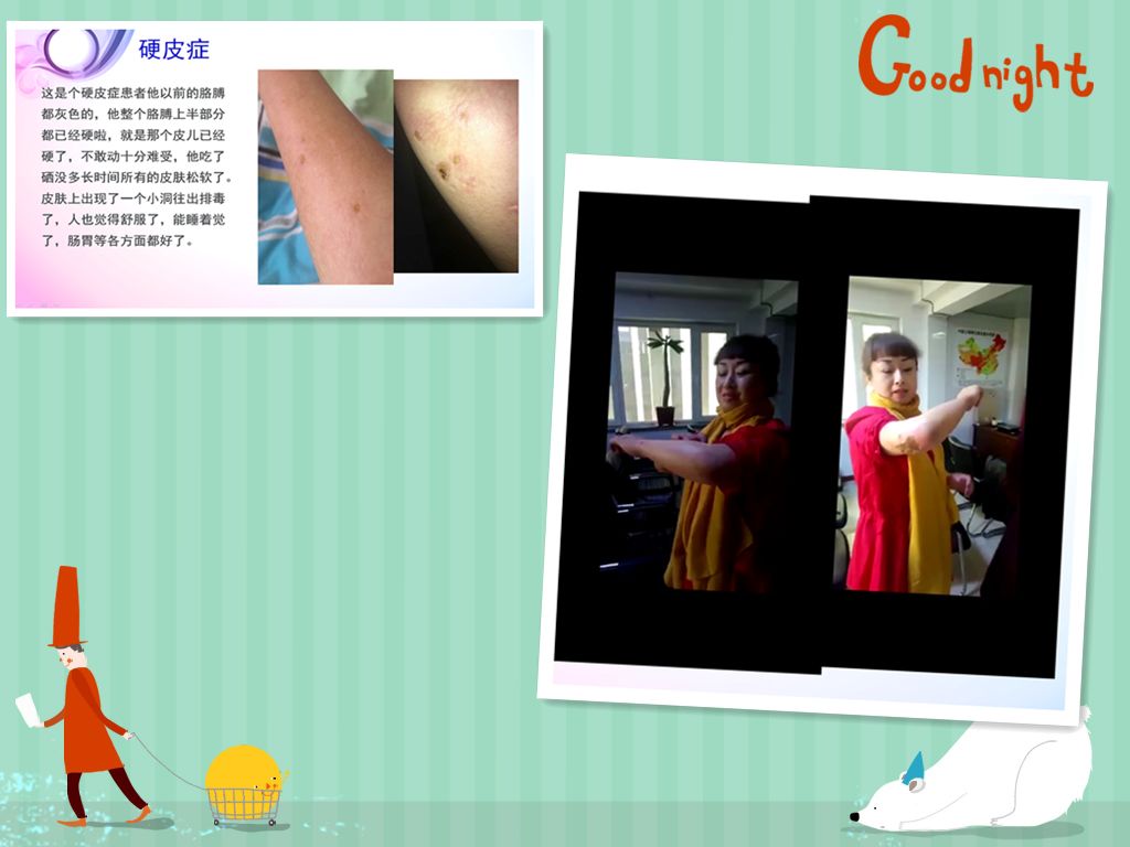 补硒对银屑病有用吗(补硒可以治疗银屑病吗)-硒宝网