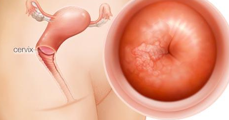 补硒抗宫颈癌有用吗(宫颈癌补硒有用吗)-硒宝网