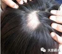 掉头发要补硒吗女的(补硒掉头发还会生长出来吗)-硒宝网