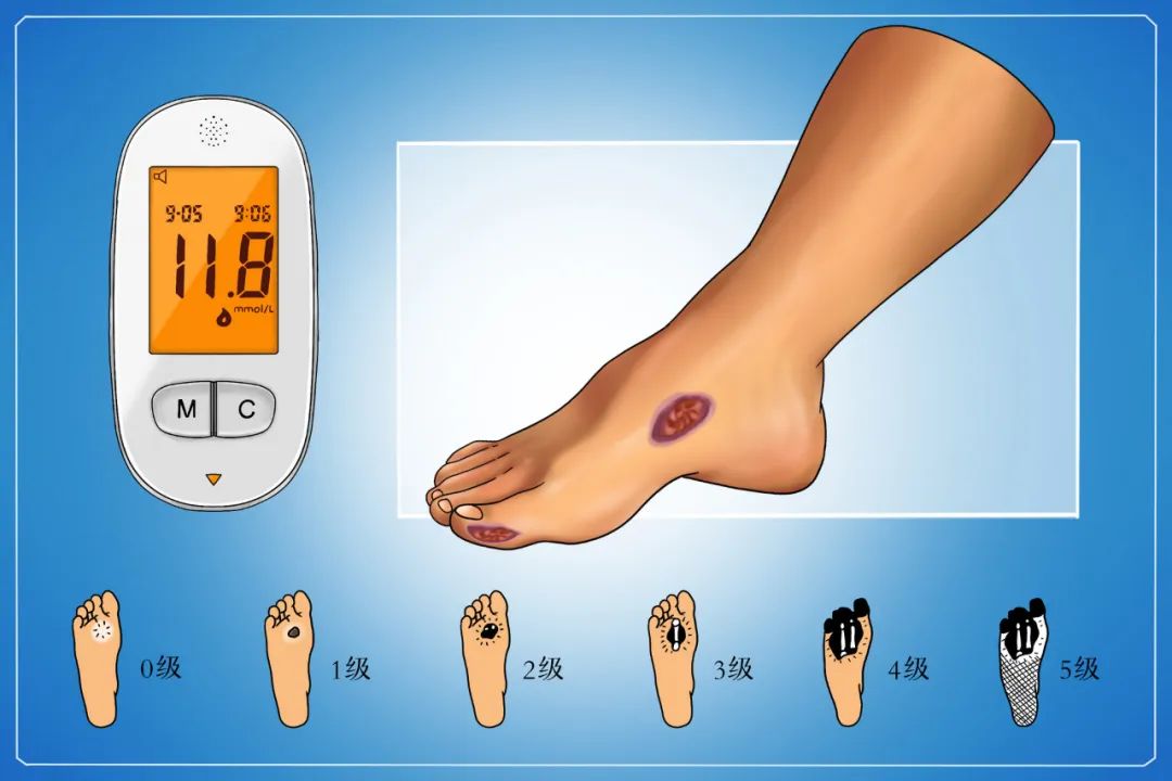 糖尿病足需要补硒吗(足病补糖尿需要硒片吗)-硒宝网
