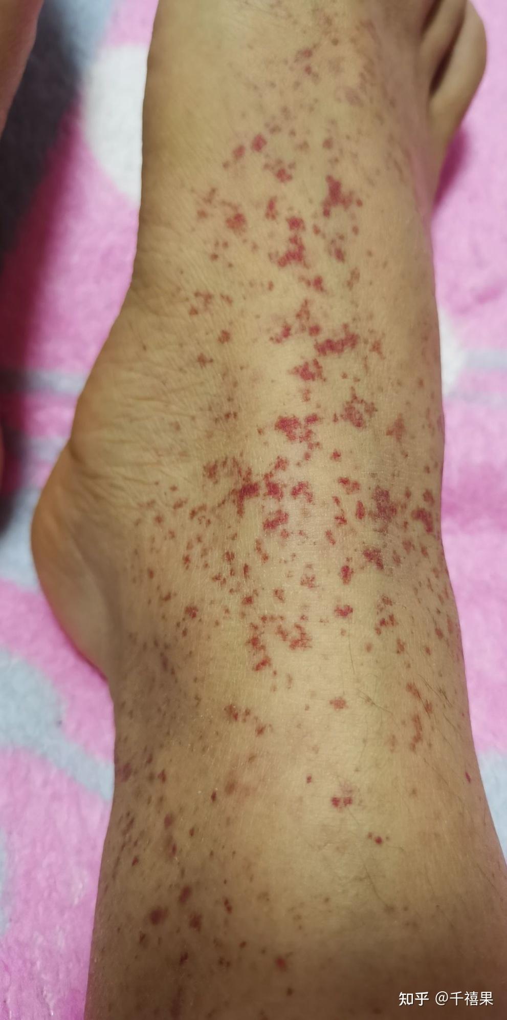 过敏性紫癜能补硒吗(过敏性紫癜能补钙锌吗)-硒宝网