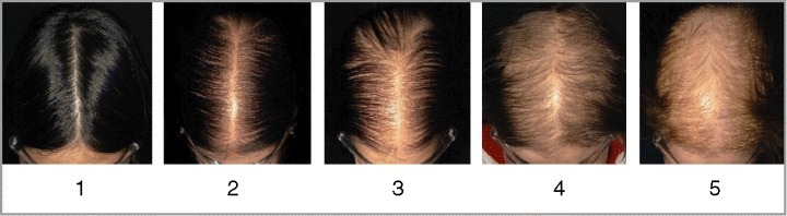 掉发是缺什么微量元素(缺微量元素头发会变白吗)-硒宝网