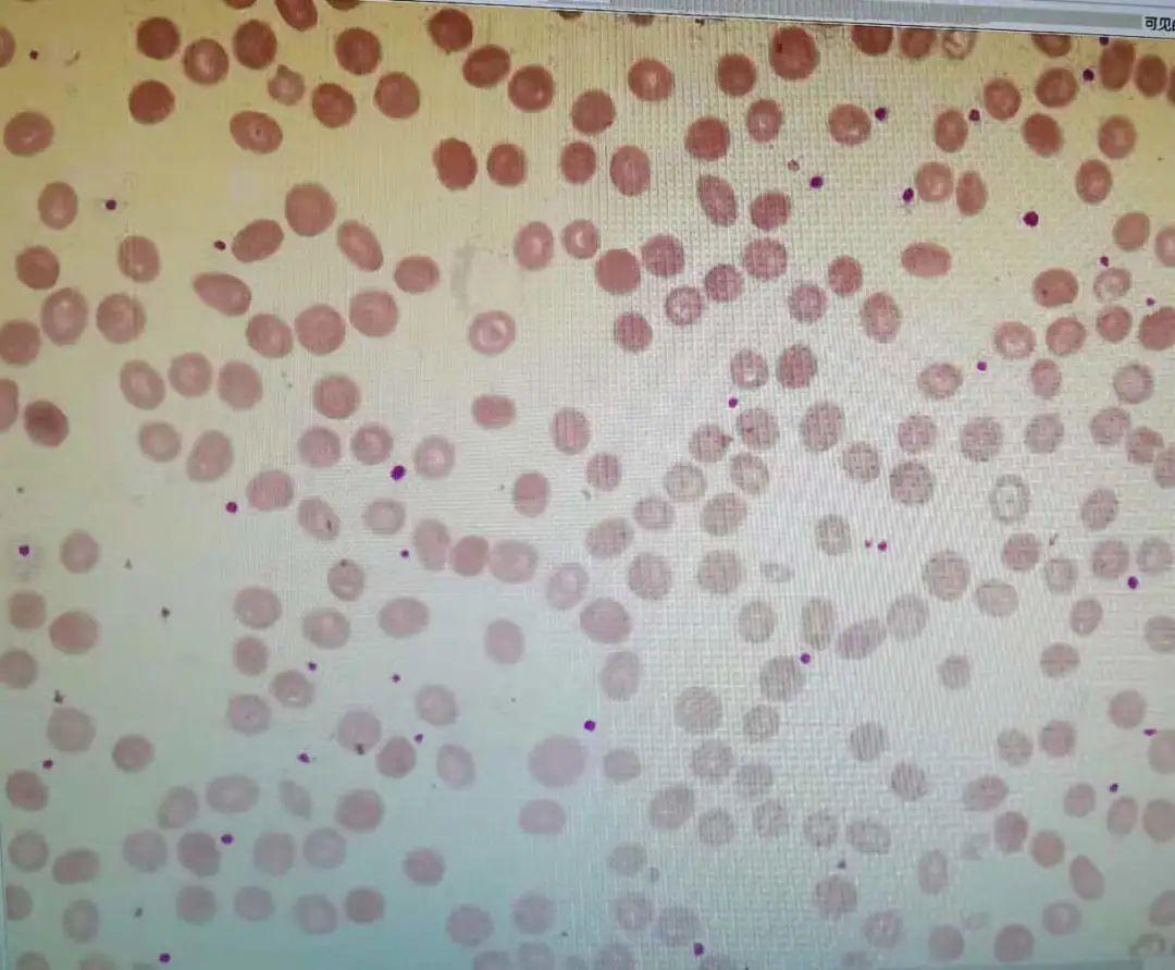 贫血补铁有用吗(贫血补铁用有副作用吗)-硒宝网