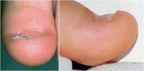 缺微量元素指甲图片（指甲缺少维生素图片）-硒宝网