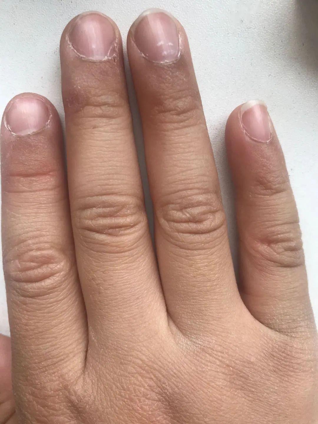 缺微量元素指甲图片（指甲缺少维生素图片）-硒宝网