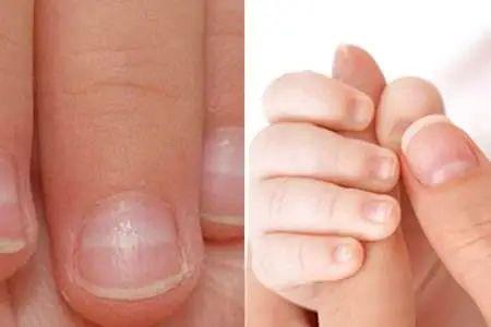 缺微量元素指甲图片（指甲缺少维生素图片）-硒宝网