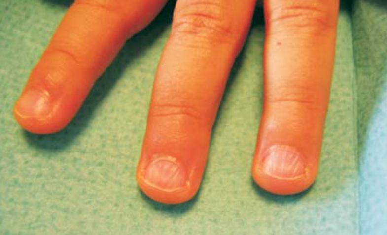 缺微量元素指甲图片（指甲缺少维生素图片）-硒宝网