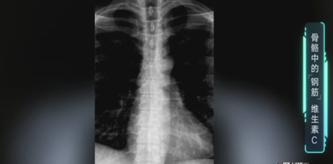 结石能补钙吗（结石补钙会加重吗）-硒宝网