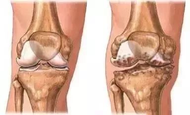 骨质增生需要补钙吗(补钙骨质增生)-硒宝网