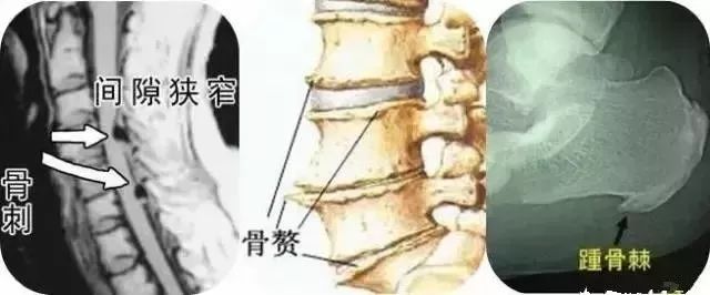 骨质增生需要补钙吗(补钙骨质增生)-硒宝网