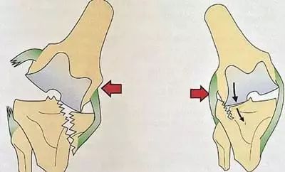 骨质增生需要补钙吗(补钙骨质增生)-硒宝网