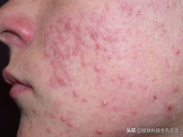 怎样补锌(补锌有什么作用和功效)-硒宝网