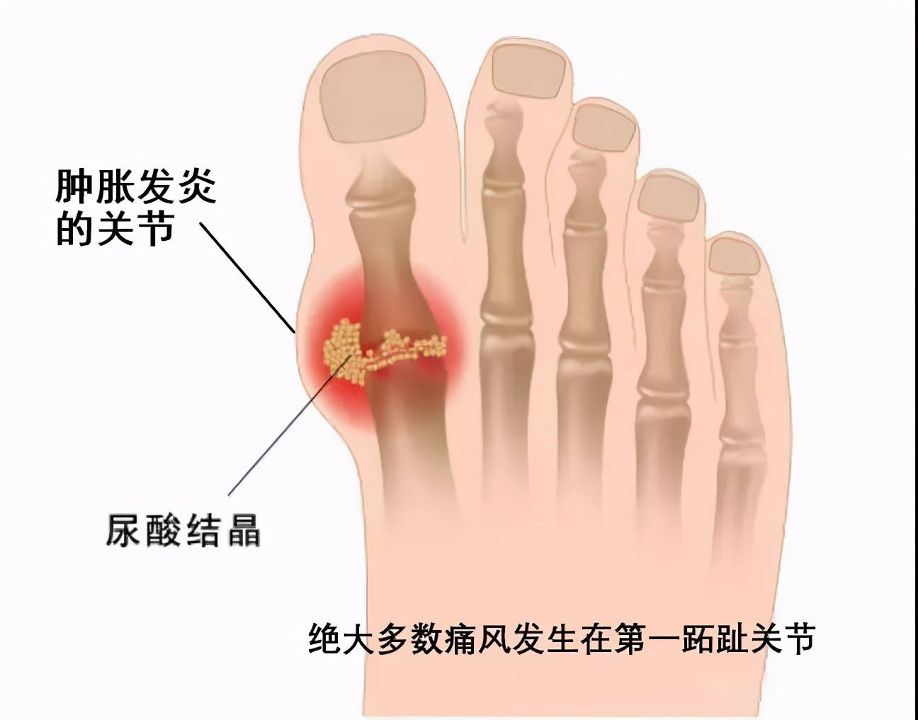 血钠低怎么补(低钠血症的补钠公式)-硒宝网