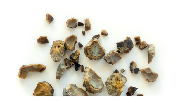 肾结石如何补钙(肾结石补钙会怎么样)-硒宝网