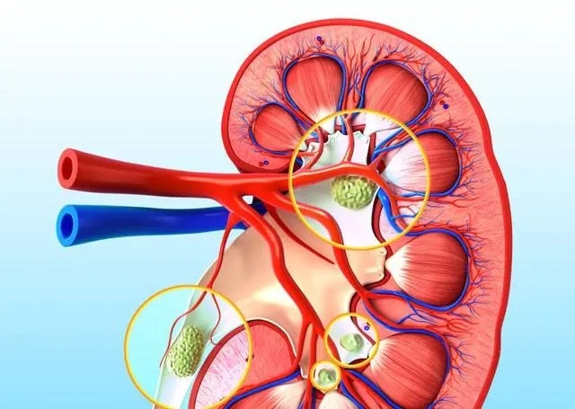 肾结石如何补钙（肾结石补钙吃什么钙好）-硒宝网