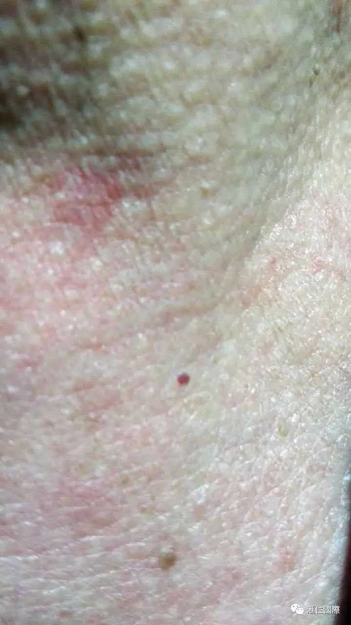 直肠癌能吃硒维康吗(肠癌病人可以吃硒酵母吗)-硒宝网