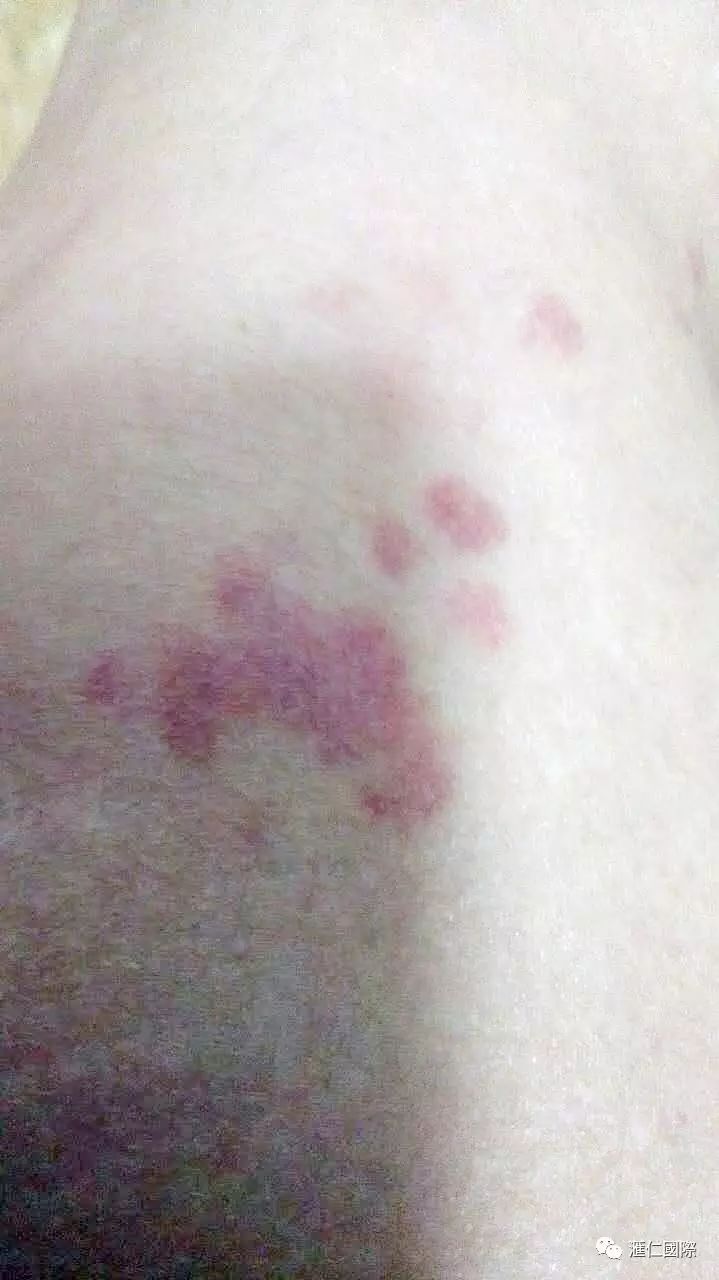 直肠癌能吃硒维康吗(肠癌病人可以吃硒酵母吗)-硒宝网