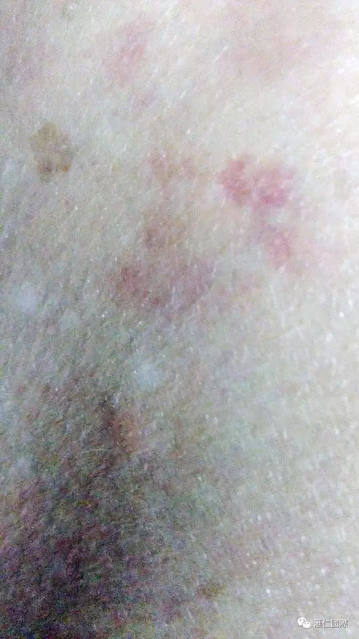 直肠癌能吃硒维康吗(肠癌病人可以吃硒酵母吗)-硒宝网