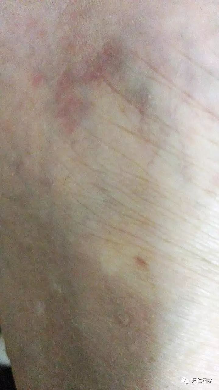 直肠癌能吃硒维康吗(肠癌病人可以吃硒酵母吗)-硒宝网