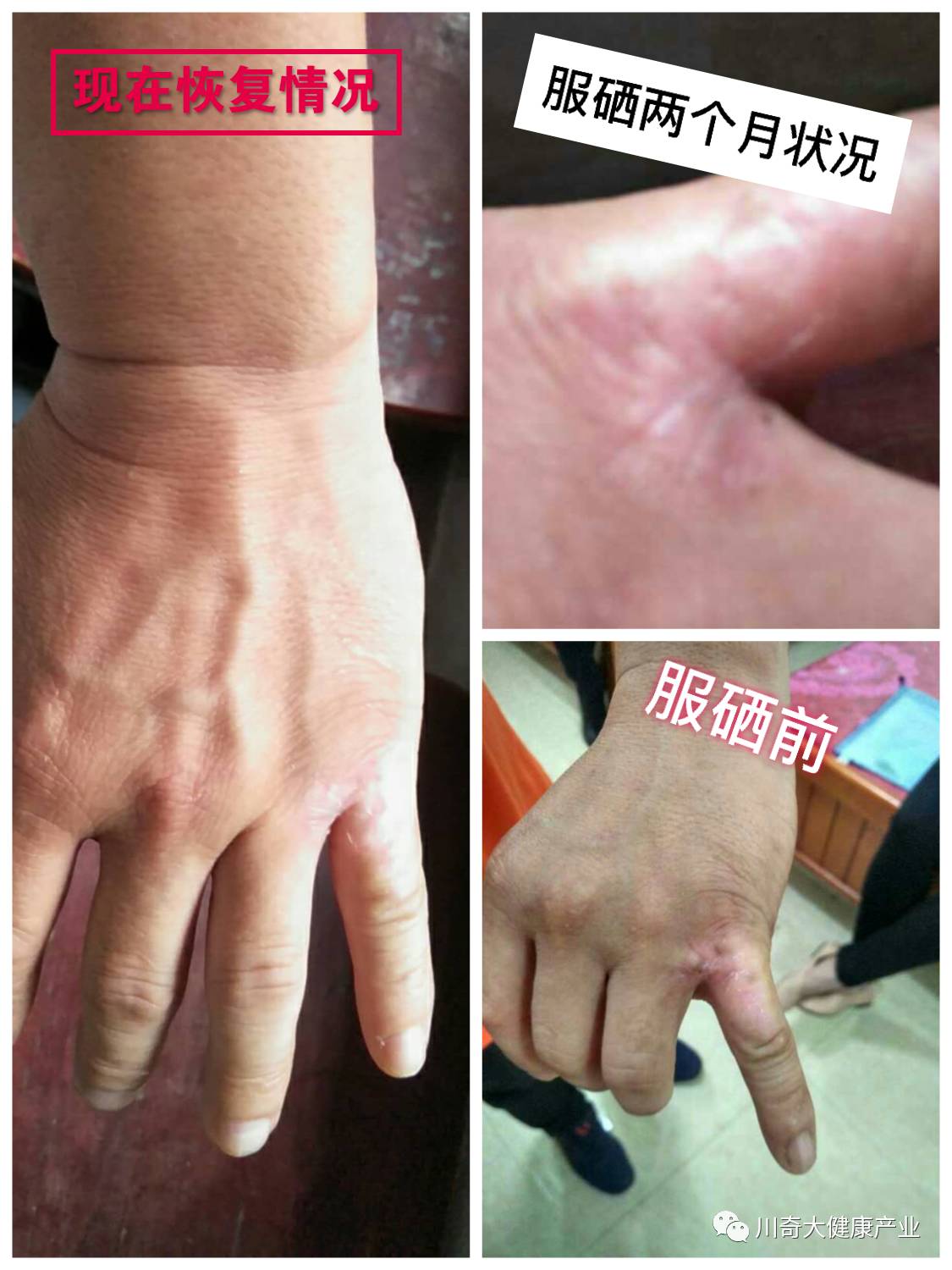 直肠癌能吃硒维康吗(肠癌病人可以吃硒酵母吗)-硒宝网