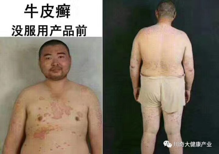 直肠癌能吃硒维康吗(肠癌病人可以吃硒酵母吗)-硒宝网