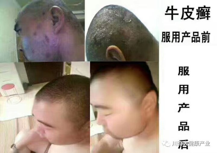 直肠癌能吃硒维康吗(肠癌病人可以吃硒酵母吗)-硒宝网