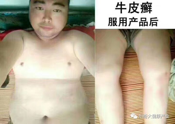 直肠癌能吃硒维康吗(肠癌病人可以吃硒酵母吗)-硒宝网